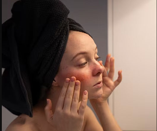 Cremas para Rosásea